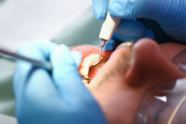 Best Dentist for Tooth Abscess  in Sur Hill, GA