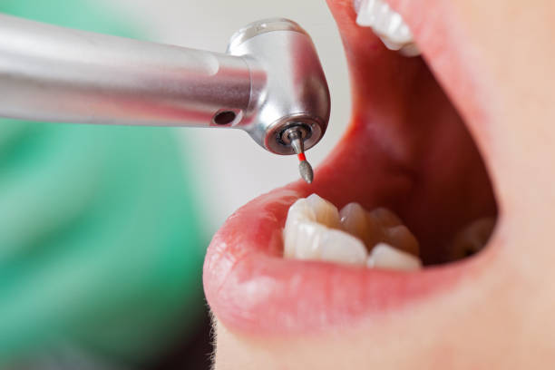 Best Chipped Tooth Repair Near Me  in Sur Hill, GA